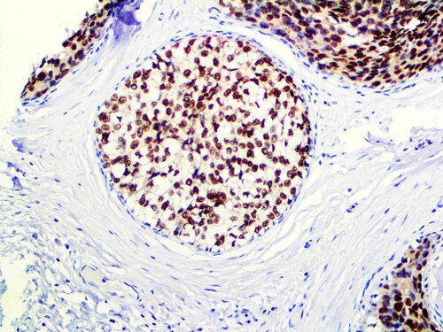 IHC of FOXA1 on an FFPE Breast Carcinoma Tissue